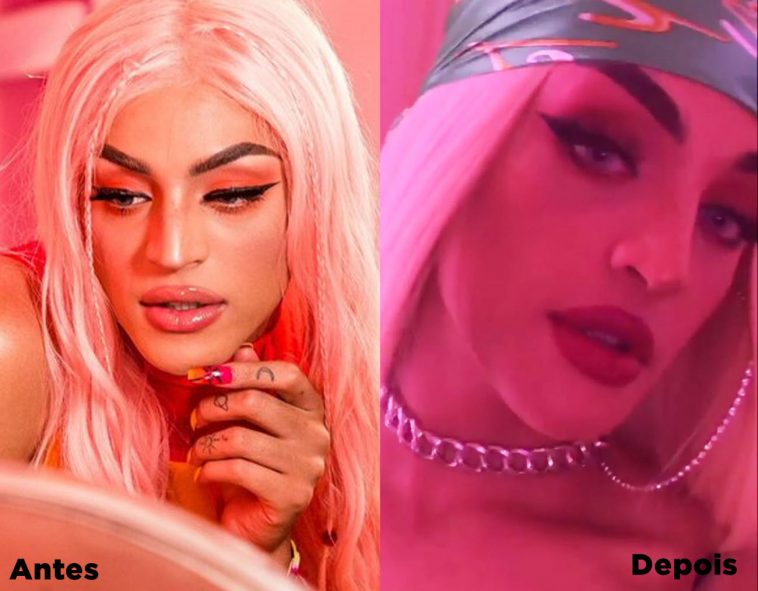 Pabllo Vittar Mostra Resultado Da Pl Stica No Nariz Popline