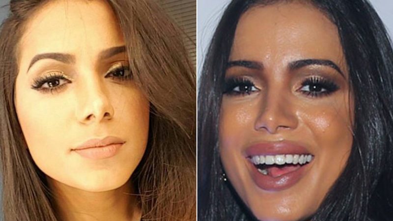 anitta-faz-preenchimento-labial