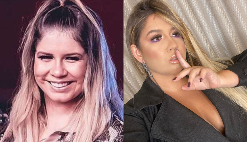 Marília Mendonça antes e depois do preenchimento labial. Foto: Divulgação