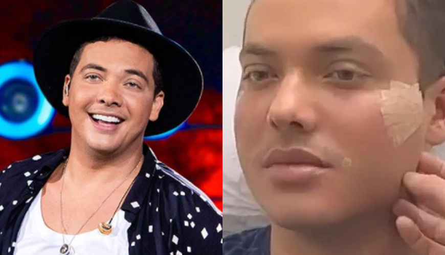 Veja o antes e depois de Wesley Safadão após cirurgia de harmonização facial. Foto: Divulgação/Instagram