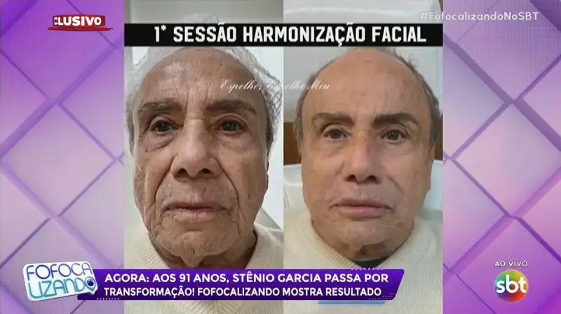Stênio Garcia passa por harmonização facial surpreendente aos 91 anos